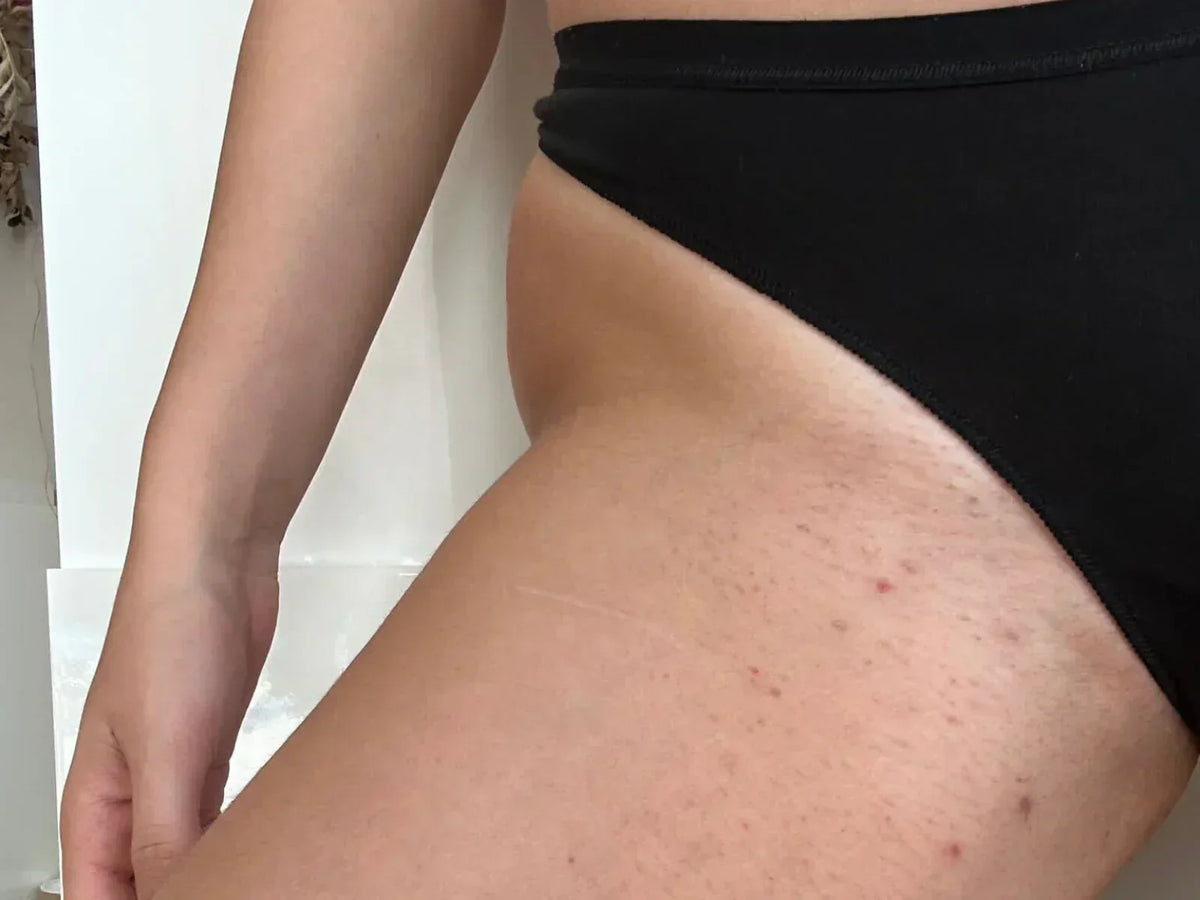 Red bumps and Ingrown Hairs: How to Say Them Goodbye Forever